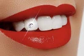 Comment bien choisir sa pose de strass dentaire ?